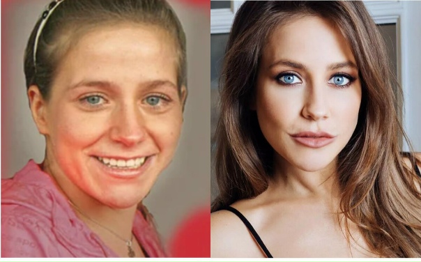 Барановская пластика до и после фото Барановская пластика до и после фото