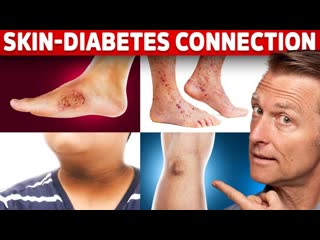 9 Diabetic Skin Problems That Indicate Diabetes